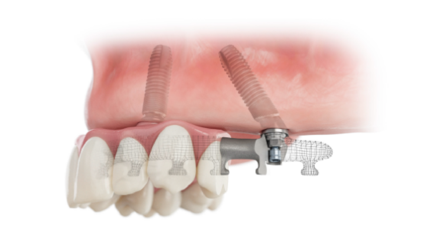 Dental Implants Course Series I Dentsply Sirona Sweden