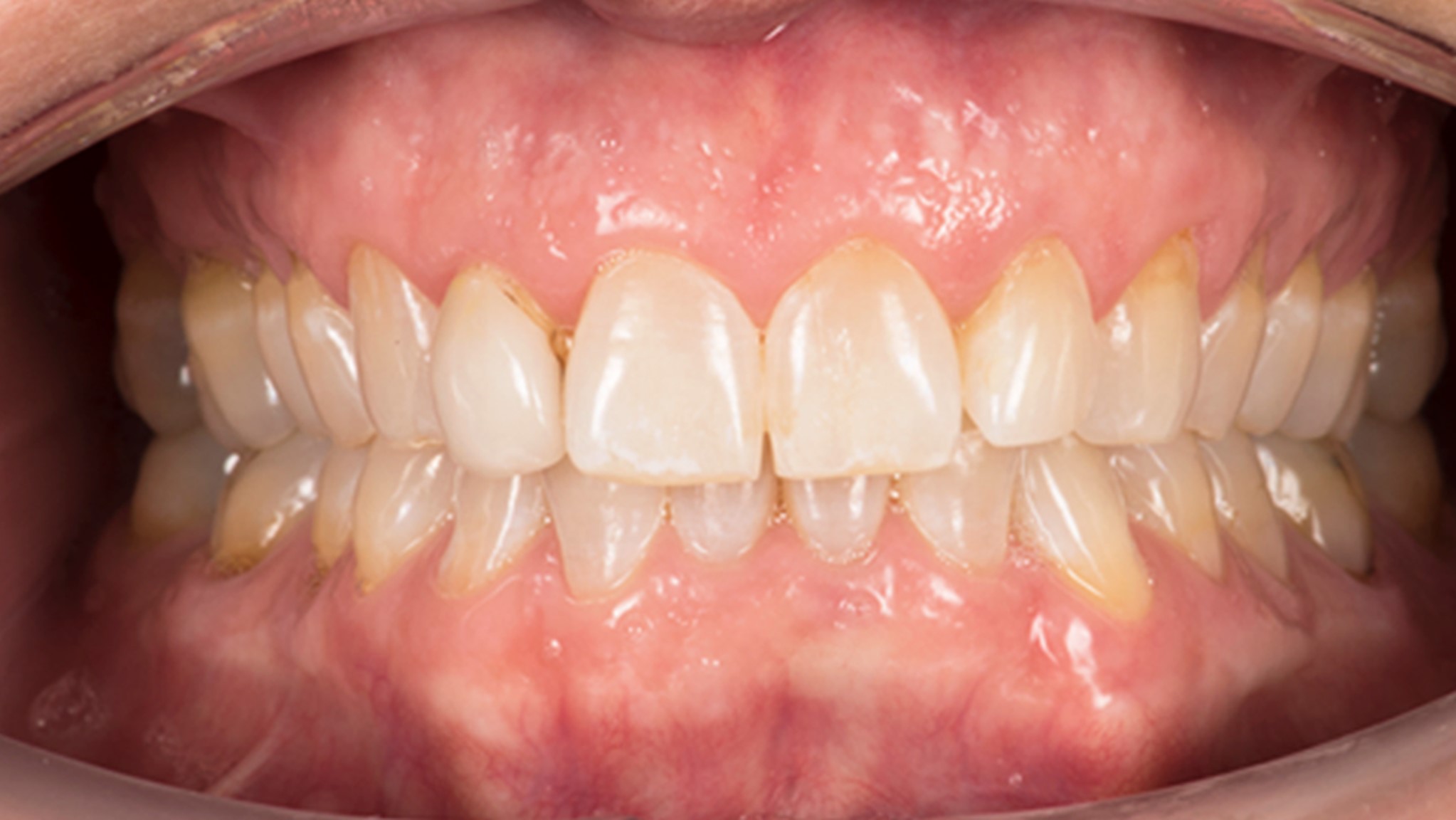 Advanced Orthodontic Innovation: Exploring Invisalign Attachments