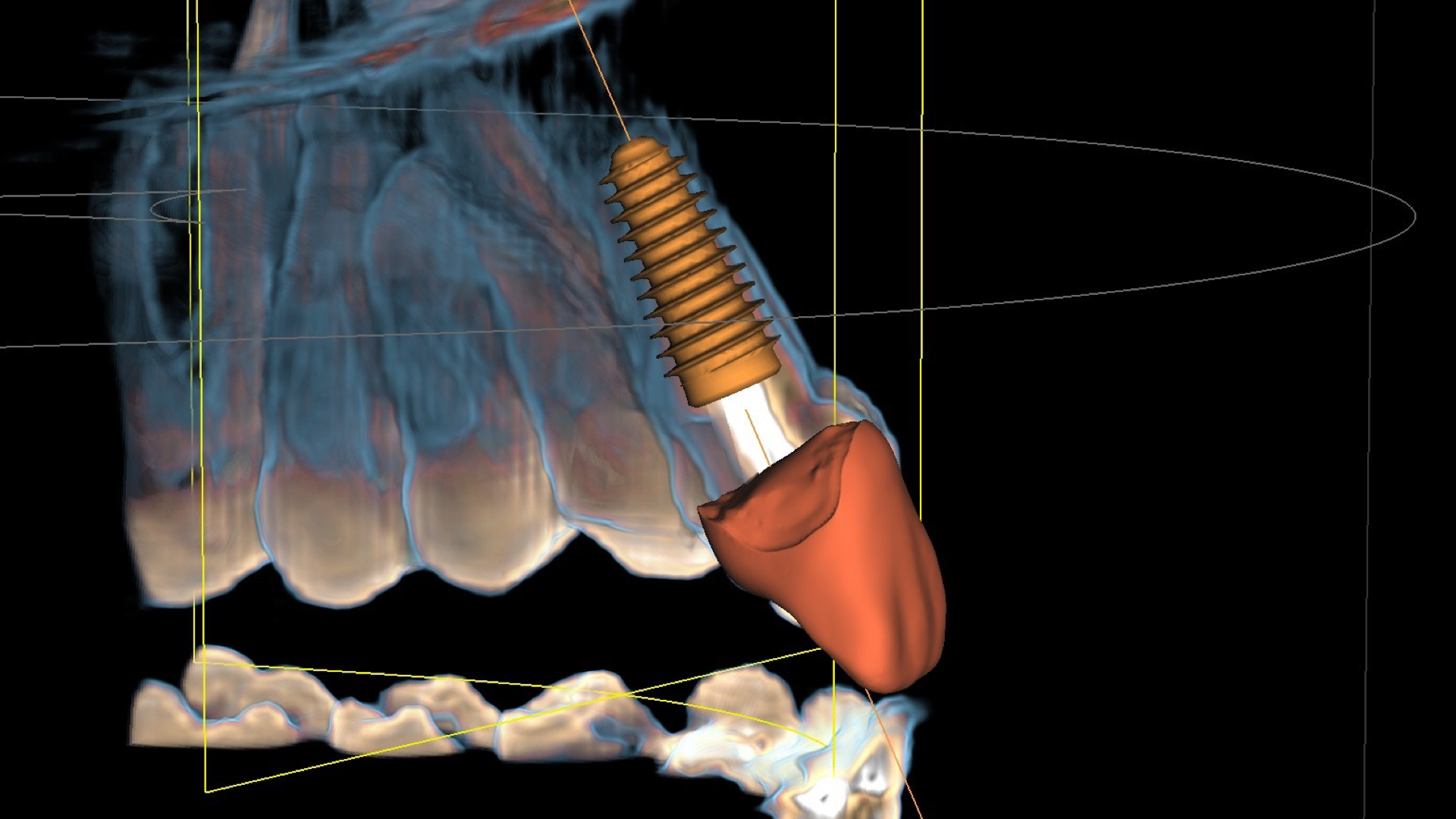 Digitale dentale Röntgensensoren für intraorales Röntgen
